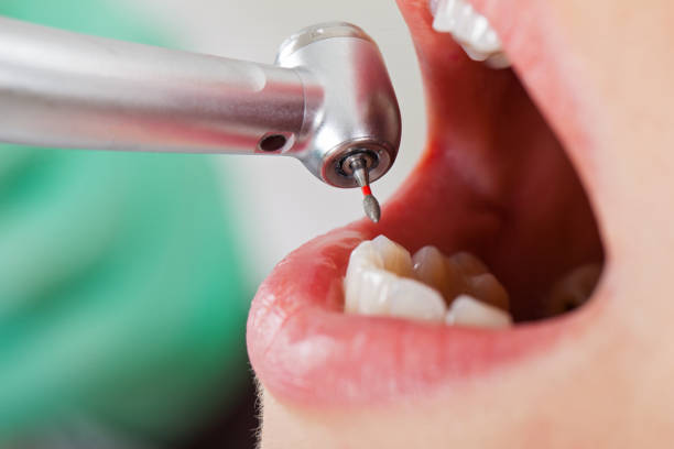 Best Emergency Wisdom Teeth Removal in Lone Tree, CO